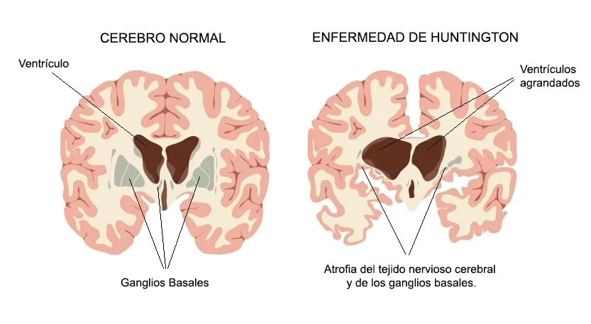 Imagen descriptiva de la diferencia de un cerebro sano y unos que padece la enfermedad de Huntington